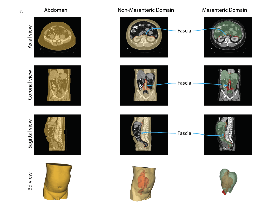 Axial, coronal, sagittal and 3D views comparing the abdomen, non-mesenteric domain and mesenteric domain, with the fascia marked.