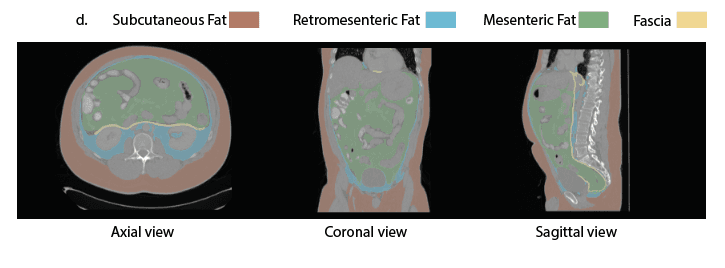 Axial, coronal and sagittal CT images with colour overlays for subcutaneous fat, retromesenteric fat, mesenteric fat and fascia.